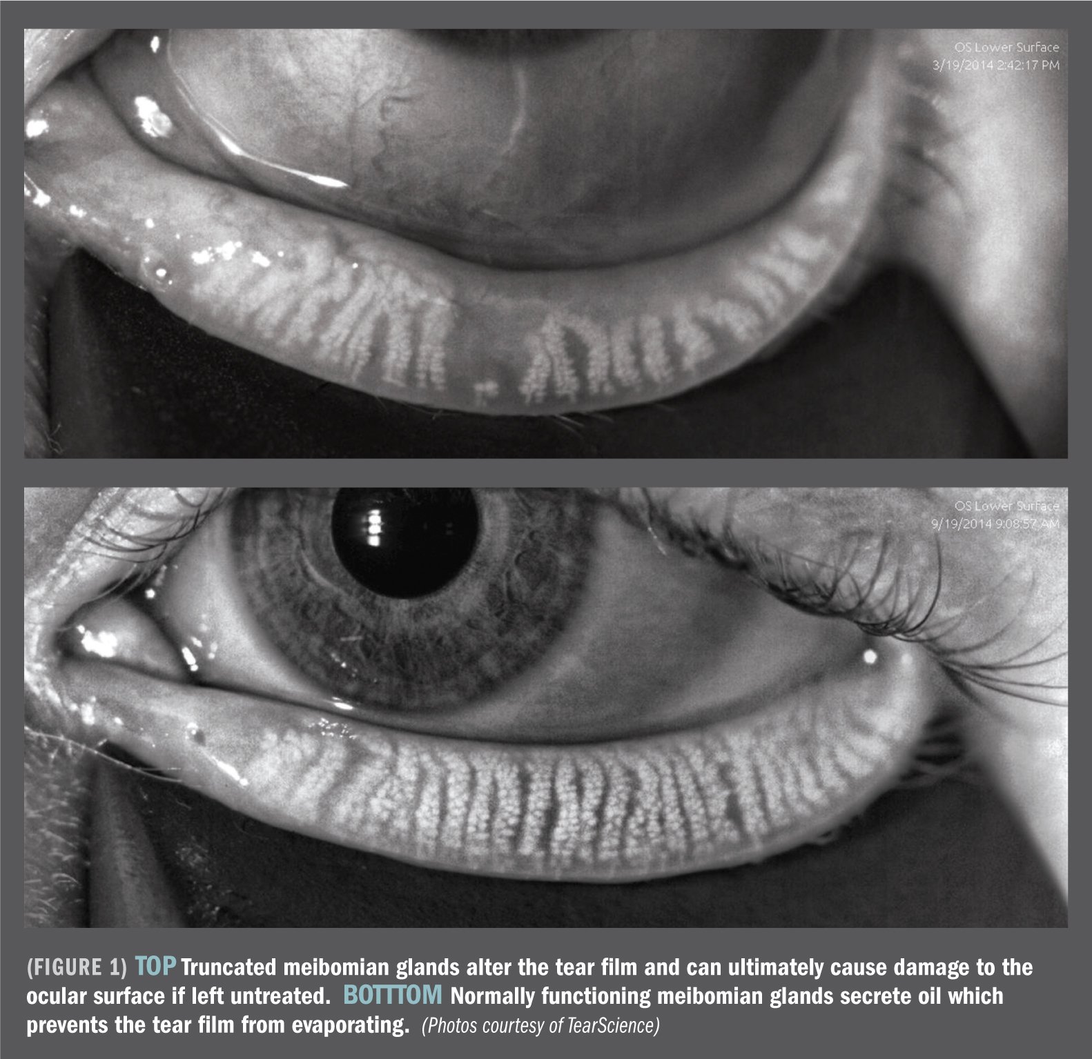 Meibomian Gland Dysfunction MGD Atasca Eye Center Meibomian Gland Dysfunction MGD Atasca Eye Center